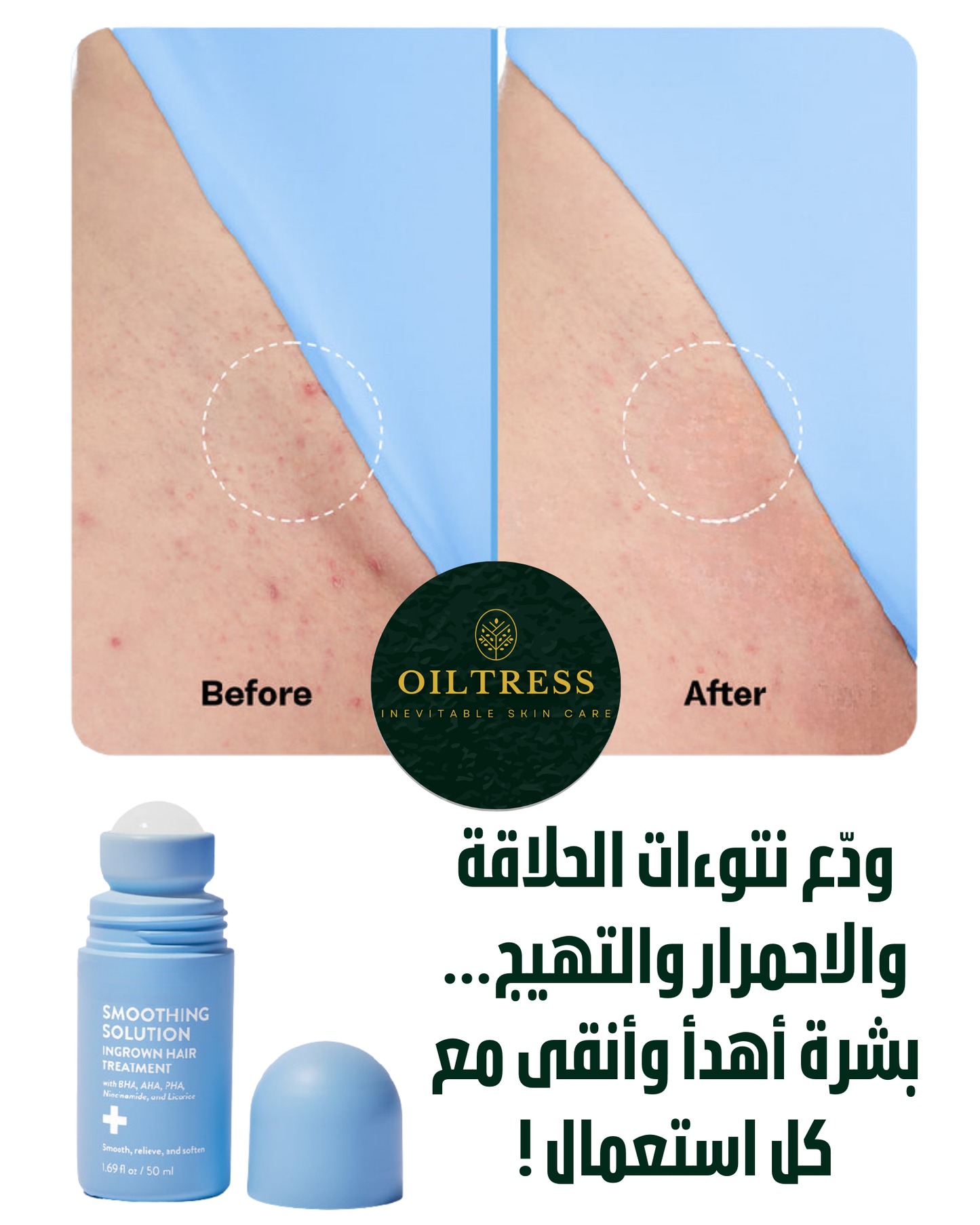 OilTress Smoothing Solution — رولّر علاج الشعر تحت الجلد ونتوءات الحلاقة